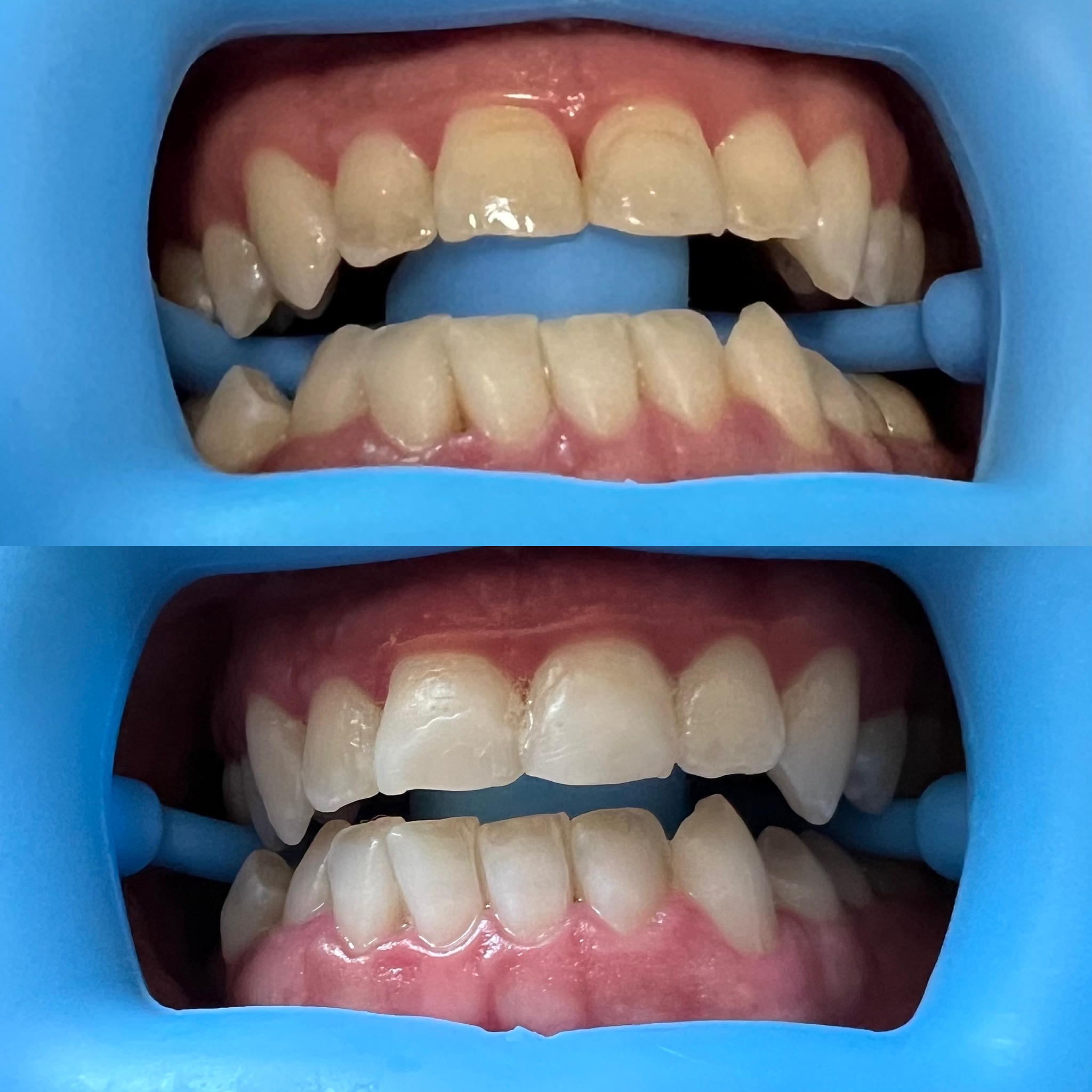 Client teeth before whitening (top) and noticeably brighter after treatment (bottom)