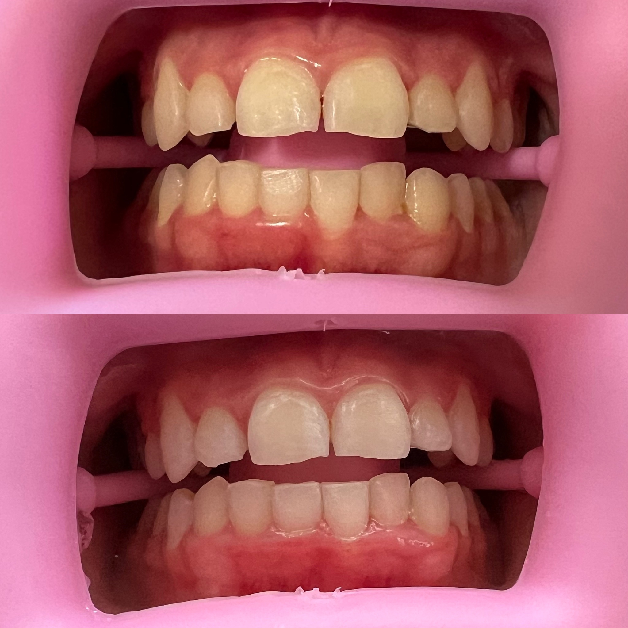 Close-up of teeth before whitening (top) and whiter after treatment (bottom)