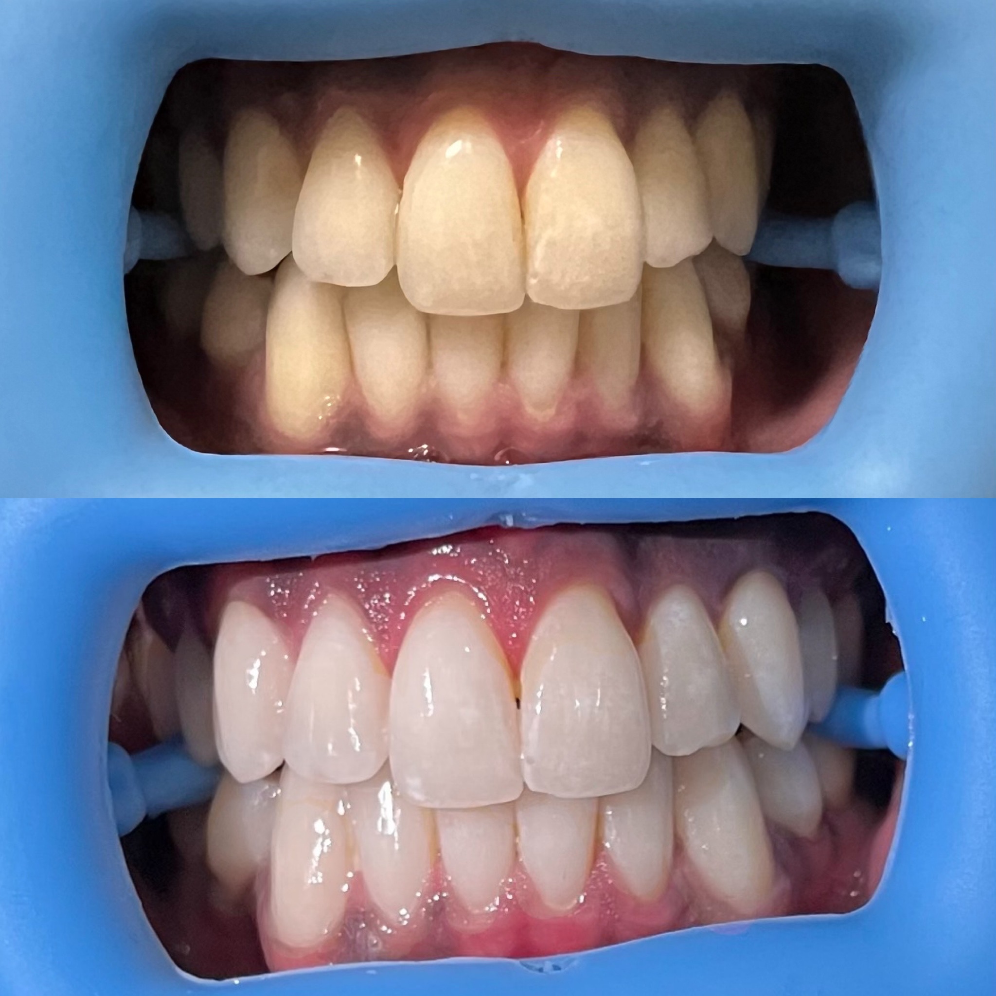 Teeth shade before whitening (top) and a lighter shade after treatment (bottom)